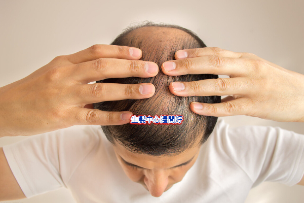 脂漏性脱毛に自毛植毛は有効か?この3つの点に注意する必要があります